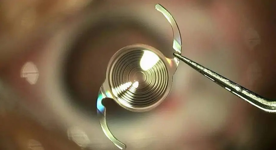 等離子處理在人工晶狀體肝素涂層過(guò)程中的應(yīng)用